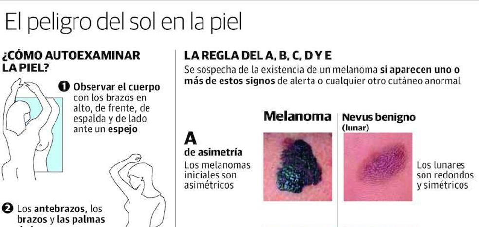 Las señales para identificar un melanoma en tu piel