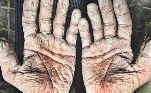 Así se le han quedado las manos a un doble campeón olímpico tras una travesía