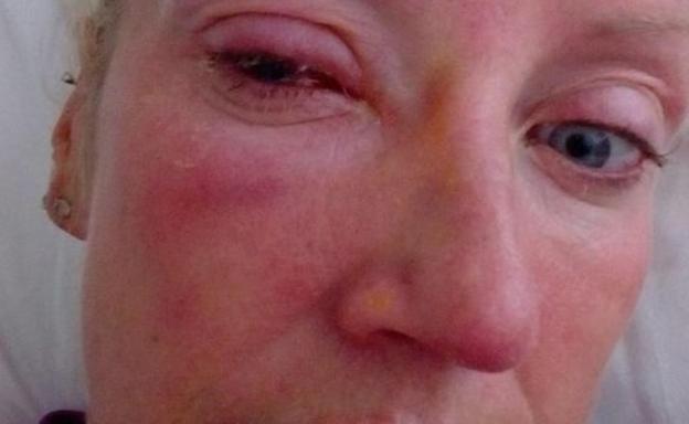 Se queda ciega por un parásito que se le pegó a la lentilla y le «devoró» el ojo