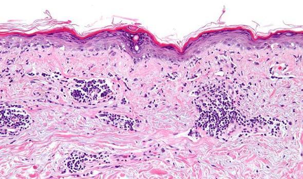 ¿Sabes qué es el Lupus?