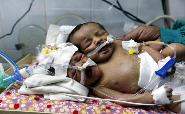 Un médico pide evacuar de Yemen a dos bebés siameses con riesgo de morir