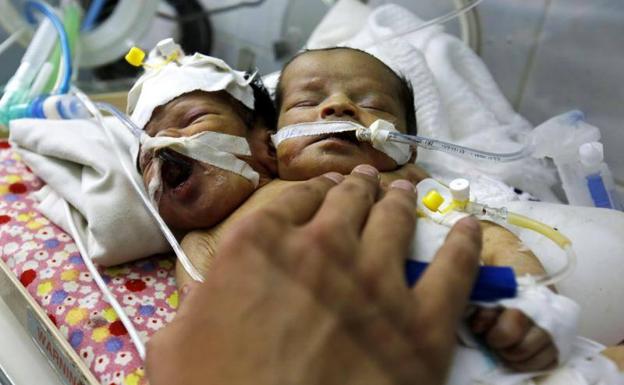 Fallecen los dos bebés siameses que no pudieron ser evacuados en Yemen
