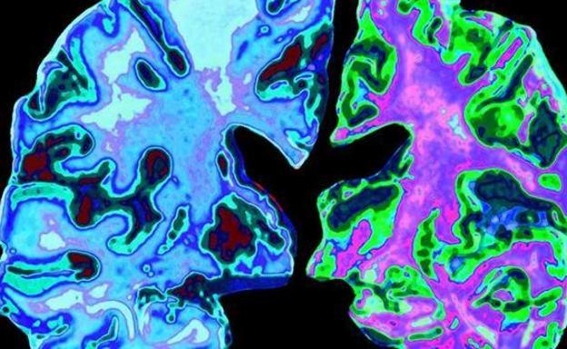 Late, la nueva demencia que se confunde con el alzhéimer