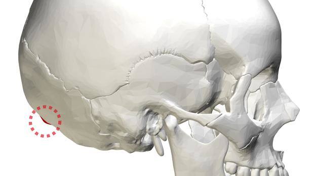 Bulto en lateral cuello