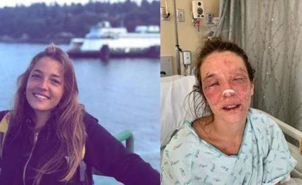 Una española residente en Seattle pierde la visión en un accidente y pide ayuda para los gastos médicos
