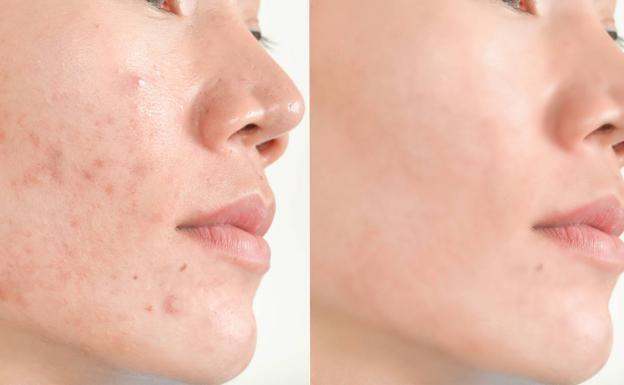 'Maskné': ¿Cómo combatir los granitos que nos salen a causa de la mascarilla?