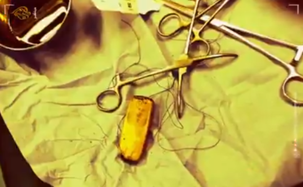 Un preso vive seis meses con un teléfono en el estómago