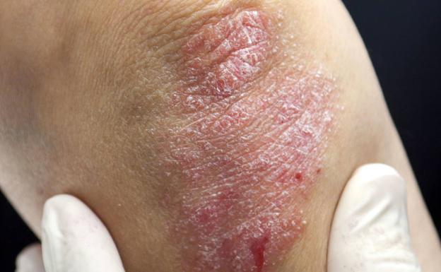 Qué es la psoriasis y por qué va más allá de la piel