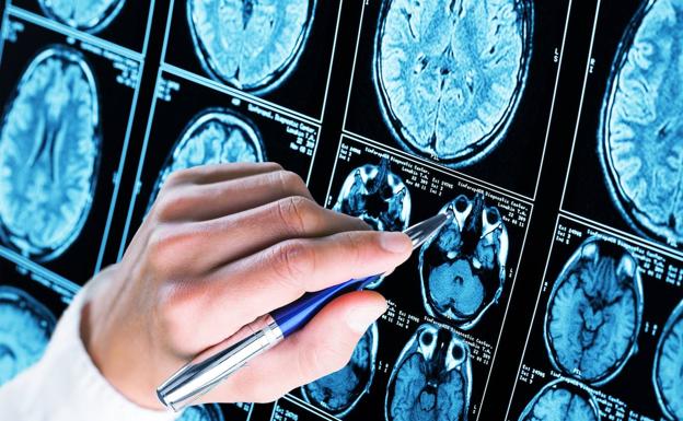 El alzhéimer vuelve a ser objeto de investigación: identifican una proteína que ayuda a recuperar la memoria