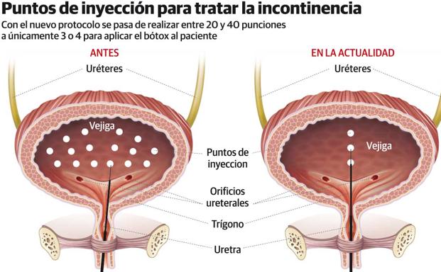 Cabueñes triplica la cifra de pacientes tratados con bótox para frenar la incontinencia