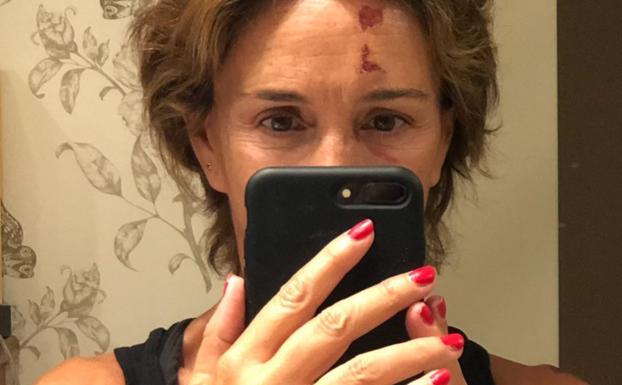 Lydia Bosch sufre un accidente: «Señales que aparecen por un golpetazo de un skate volador»