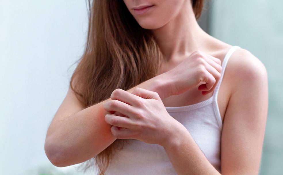 Dermatitis atópica y salud mental: ¿cómo le afecta?