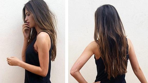 Sara Carbonero muestra sus cicatrices