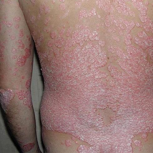 El 70% de los afectados de psoriasis afirma que la enfermedad limita mucho su vida