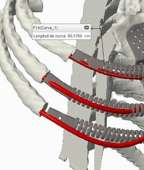 Implantada una prótesis biomecánica torácica a medida impresa en 3D