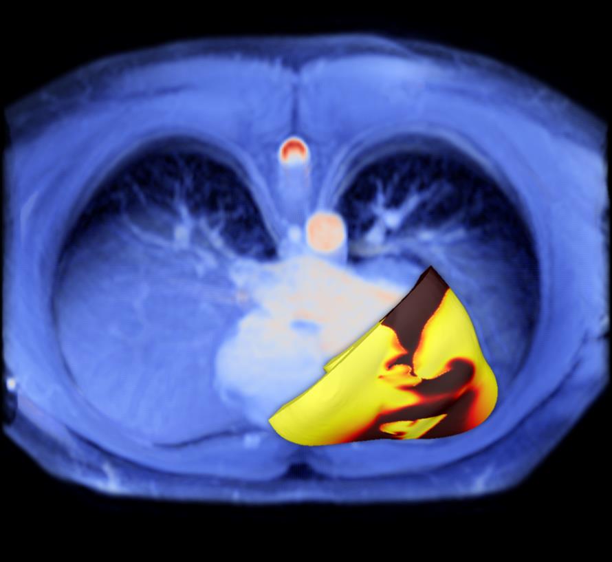 Un modelo virtual 3D de corazones infartados para evitar muertes súbitas